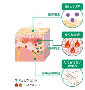 投稿についてもっと詳しく アトピー|「あとちょっと」が治らない君へ。最新の注射治療「デュピクセント」ってなに？