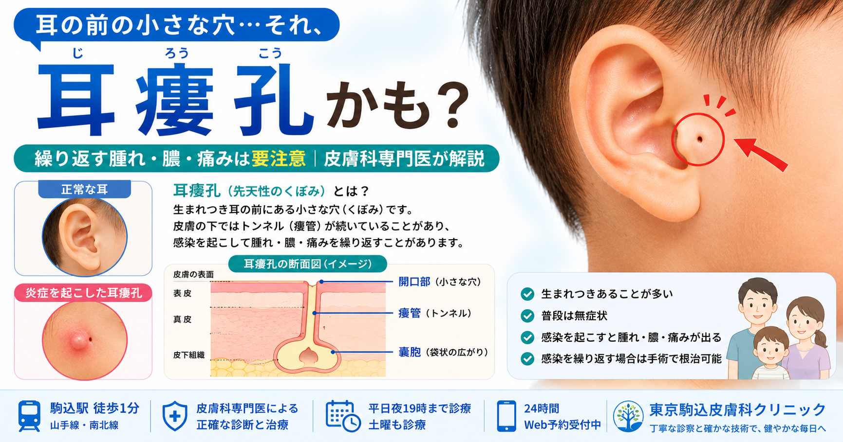 投稿についてもっと詳しく 耳の前の小さな穴から臭い汁が…「耳瘻孔」が腫れる原因と根治手術について専門医が解説