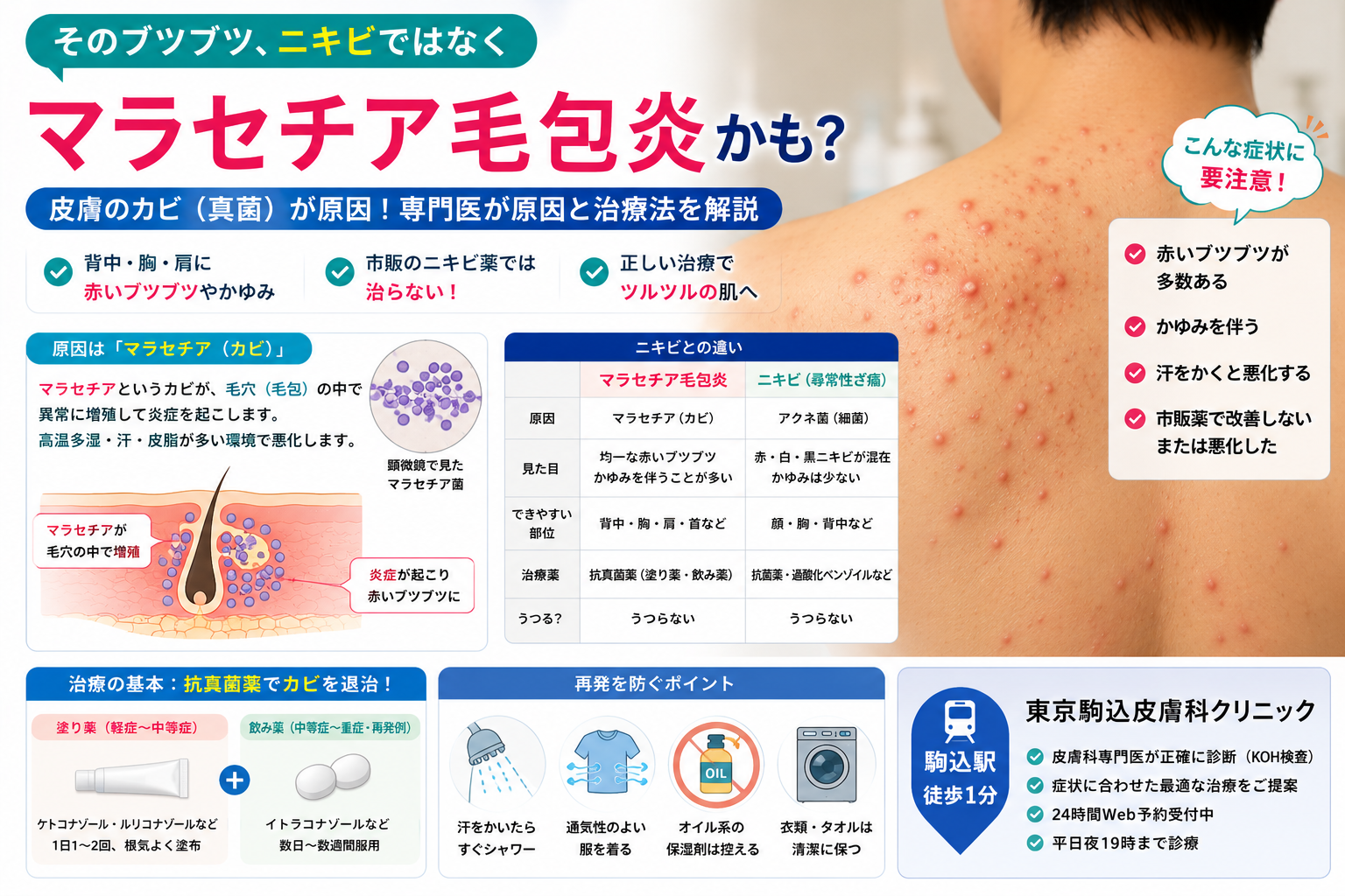 投稿についてもっと詳しく 背中や胸のブツブツはニキビじゃない？「マラセチア毛包炎」の原因と治療法を専門医が解説