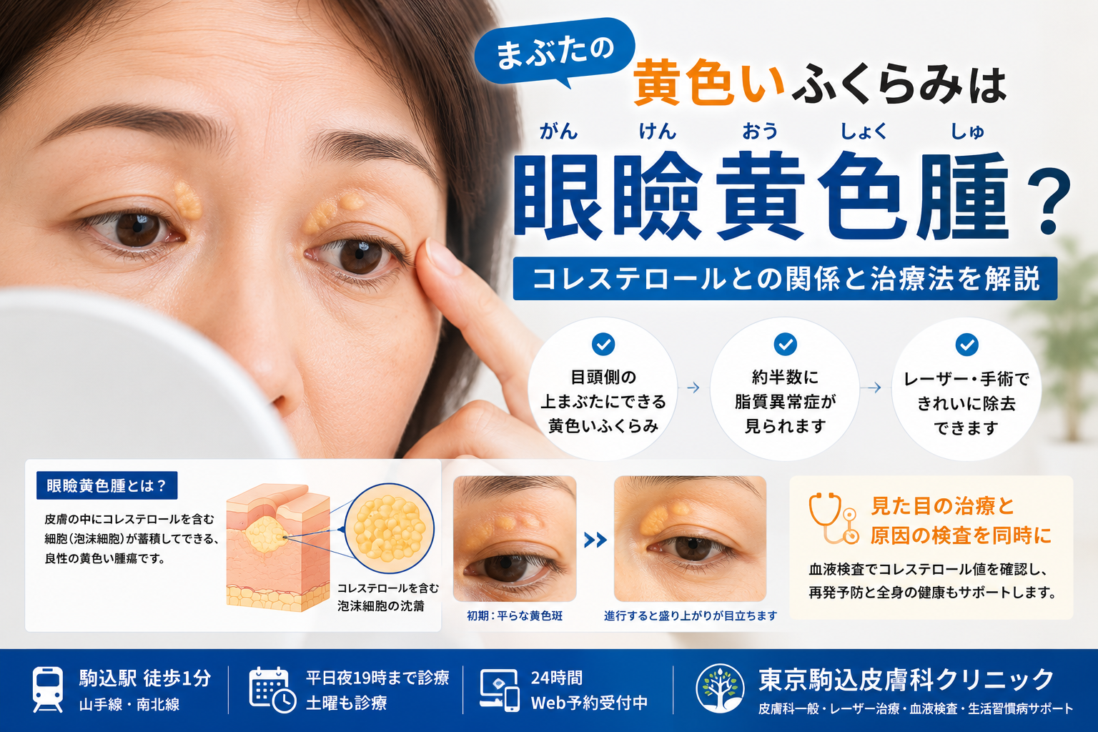 まぶたの黄色いふくらみは「眼瞼黄色腫」？コレステロールとの関係と治療法を専門医が解説