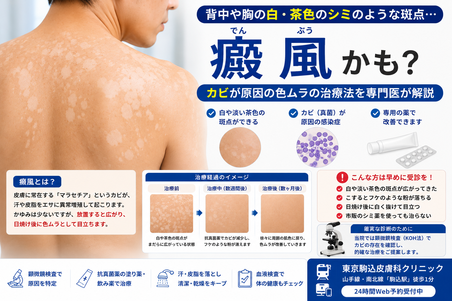 背中や胸の白・茶色のシミは「癜風」？カビが原因の色ムラの治療法を専門医が解説