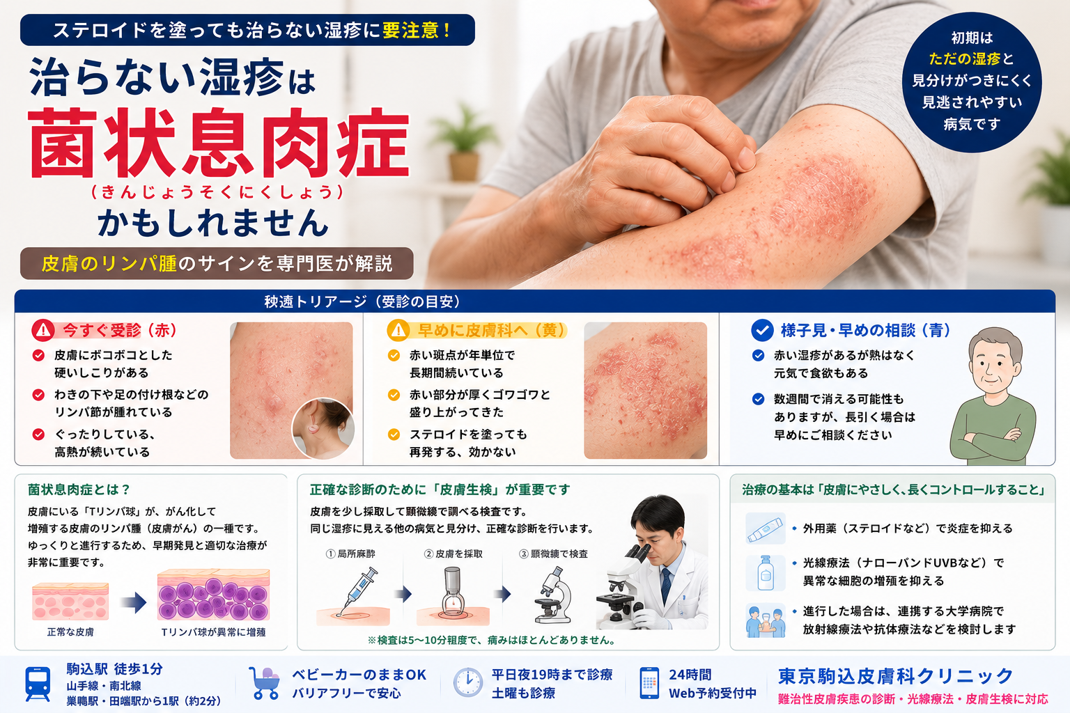 投稿についてもっと詳しく 治らない湿疹は「菌状息肉症（皮膚のリンパ腫）」かも？症状と治療法を専門医が解説