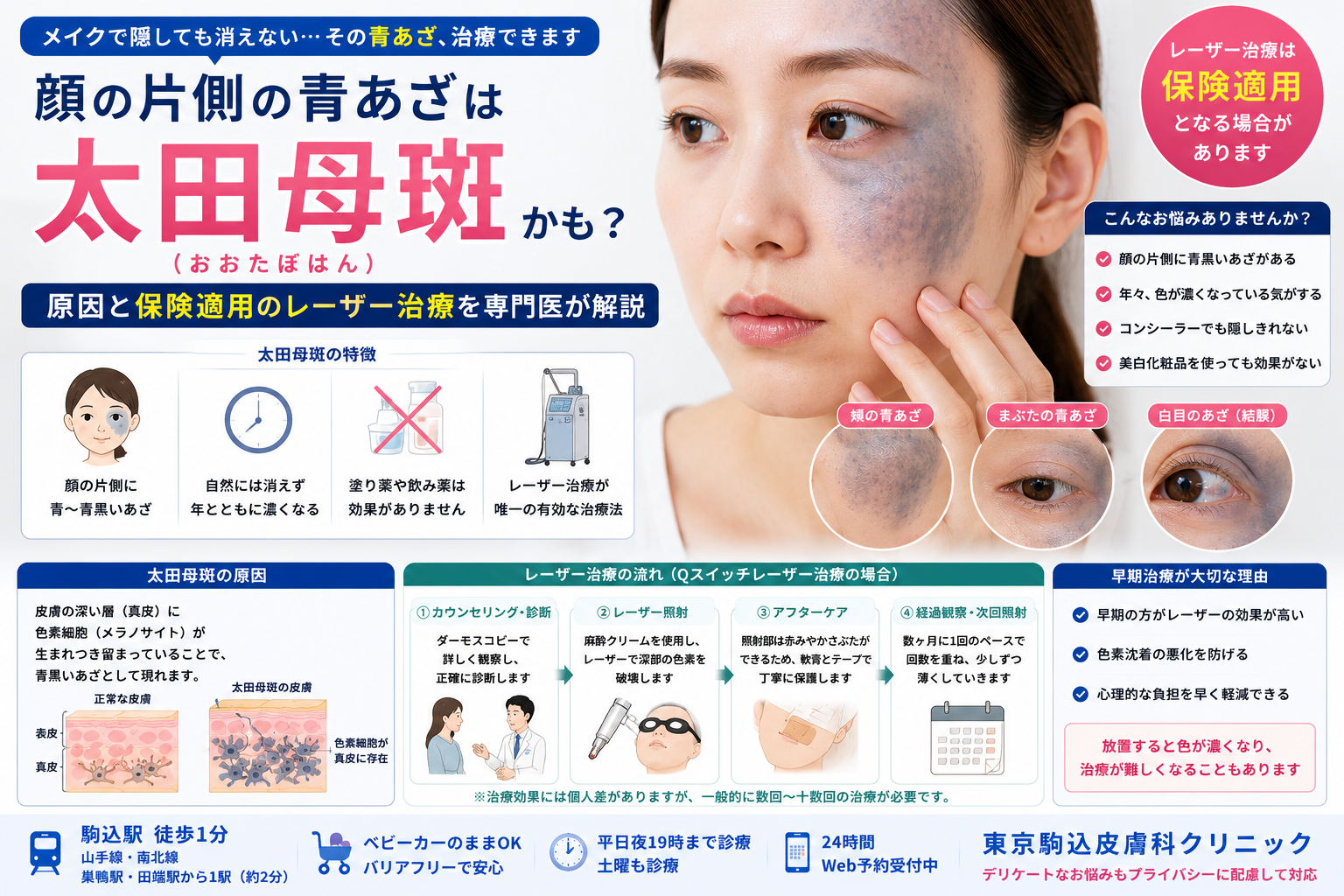 投稿についてもっと詳しく 顔の片側の青あざは「太田母斑」？原因と保険適用のレーザー治療を専門医が解説