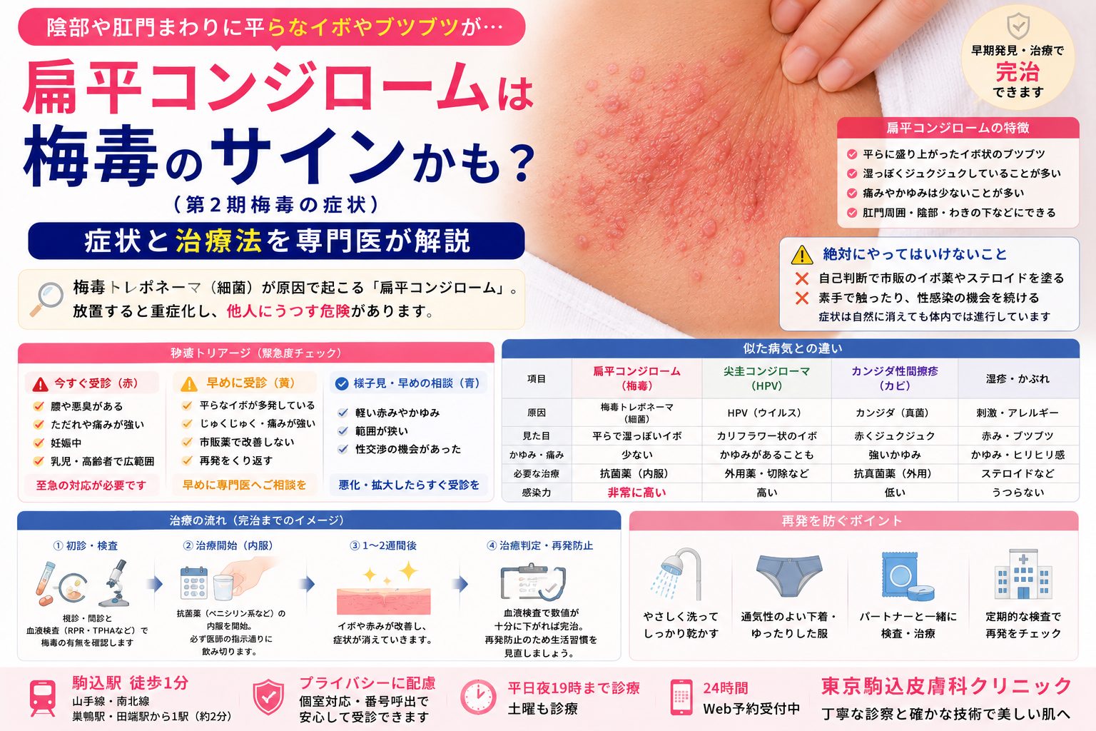 陰部や肛門まわりの平らなイボは梅毒（扁平コンジローム）？症状と治療法を専門医が解説