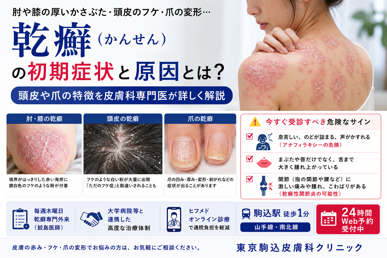 投稿についてもっと詳しく 乾癬（かんせん）の初期症状・原因とは？頭皮や爪の特徴を皮膚科専門医が解説