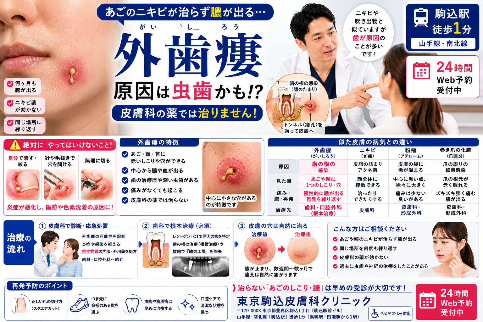 投稿についてもっと詳しく あごのニキビが治らず膿が出る…「外歯瘻（がいしろう）」の原因と正しい治療ルートを専門医が解説