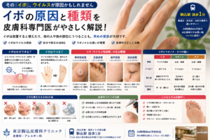 投稿についてもっと詳しく イボはなぜできる？うつる？ウイルス性イボの原因と種類を皮膚科専門医が解説